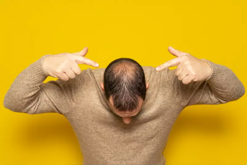 how to stop receding hairline